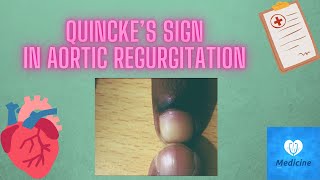 Quincke’s sign  Aortic regurgitation  medicine physical examination [upl. by Anailuj]