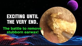 The war against earwax is raging A lot of earwax has been removed [upl. by Akcebar159]