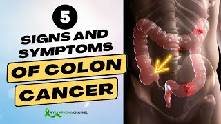 5 Signs and Symptoms of Colon Cancer [upl. by Lebatsirc]