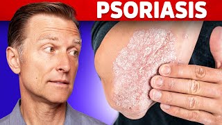 Psoriasis Treatment – The Best 3 Remedies for Psoriasis – DrBerg [upl. by Shafer543]