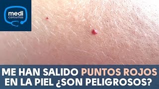 URTICARIA RONCHAS EN EL CUERPO CAUSAS SÍNTOMAS Y TRATAMIENTO [upl. by Garcon]