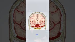 Subarachnoid hemorrhage is the result of a brain aneurysm brain brainbleed doctor medical [upl. by Yunfei332]