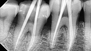 RCT root canal treatmentwrt 46 amp 47 mandibular 1st amp 2nd molarfollowed by zirconia crown [upl. by Kopans]