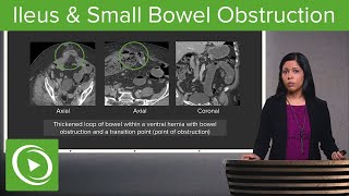 Bowel Obstruction and Ileus Ileus amp Small Bowel Obstruction – Radiology  Lecturio [upl. by Nikral508]