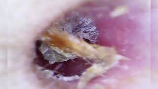 Ultimate Ear Wax Removal  Satisfying Ear Cleaning for Clear 2 [upl. by Nellaf]