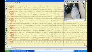 Video Electroencephalogram Dr Loredo Ritter [upl. by Wyon592]