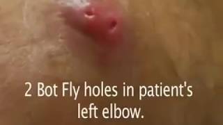 Big Botfly Removal From Human Skin [upl. by Lemor]