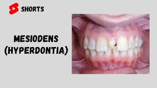 Mesiodens  Supernumerary Tooth [upl. by Amiarom]