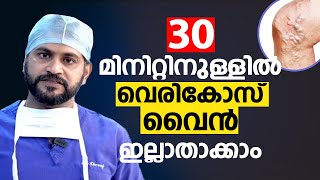 30 മിനിറ്റിനുള്ളിൽ വെരികോസ് വൈൻ ഇല്ലാതാക്കാം  VenaSeal Varicose Vein Treatment [upl. by Nylanaj233]