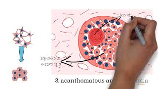 Ameloblastoma part 2 [upl. by Savick456]