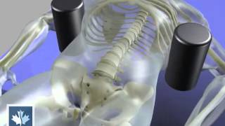 Sciatica  Spinal Decompression  Back Clinics of Canada [upl. by Sufur771]