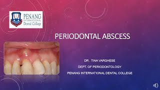 Periodontal Abscess [upl. by Ecyarg]