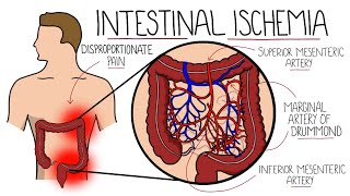 Intestinal Ischemia  Mesenteric Ischemia Acute amp Chronic amp Ischemic Colitis [upl. by Trub]