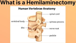 What is a Hemilaminectomy [upl. by Othe606]