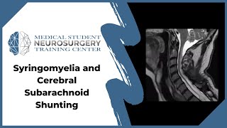 Syringomyelia and Cerebral Subarachnoid Shunting [upl. by Kory]