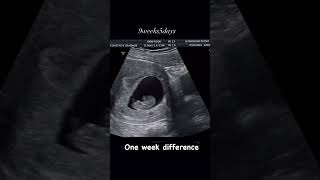 9 week baby movement in womb pregnancy ultrasound pregnancycare [upl. by Suhpoelc]