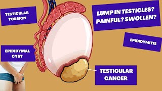 Ive found A Lump In My Testicle Could It Be TESTICULAR CANCER  Causes of Testicular PainLumps [upl. by Nanice5]