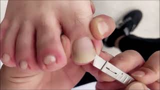 satisfying ingrown toenail removal 011 [upl. by Laeynad]