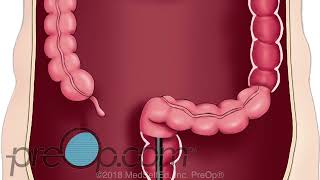 PreOp® Colonoscopy Lower Endoscopy [upl. by Nostaw42]