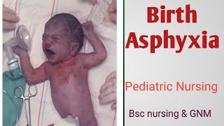 Birth asphyxia or Asphyxia neonatorum [upl. by Pass621]