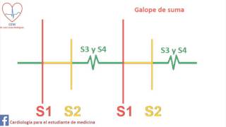 Auscultación del Galope de suma [upl. by Assilac]