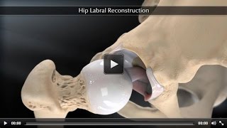 Hip Labral Reconstruction [upl. by Johnsson]