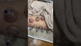 Cupping Therapy for lower backhamstring amp calf musclescupping cuppingtherapy myotherapy [upl. by Akimet55]