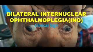 Bilateral Internuclear Ophthalmoplegia INO  WEBINO  EBINO  Clinical Sign  Neurology [upl. by Harsho538]