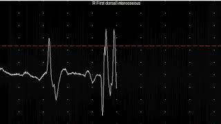 EMG teaching video 20 Myotonia [upl. by Oikim]