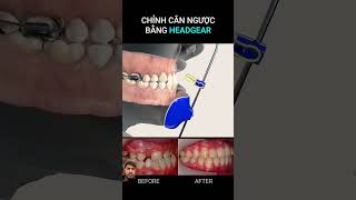 Cp pharmacist braces orthodontics shortvideo dentalclinic anatomy duet doctor braces pharma [upl. by Neely]