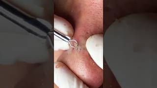 Éclatement de Boutons Extrêmeblackheads acne asmrvideo [upl. by Eerrahs]