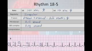 Basic Electrophysiology part 7  Atrial Rhyhtms part 2 WAP MAT EAT SVT [upl. by Nahtaneoj]