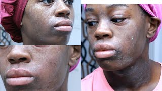 Living With A Rare Skin DISEASE  How I cleared My Eczema In 4 Days  De Sade [upl. by Neirbo]