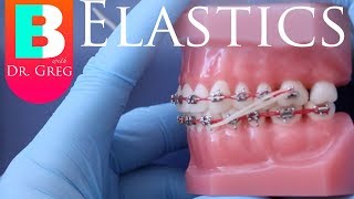 BRACES EXPLAINED Elastics  Rubber Bands [upl. by Huppert]