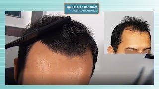 2600 Graft Hair Transplant Results  Feller amp Bloxham Medical  NY NYC Long Island [upl. by Ikcaj]