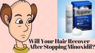 Will Your Hair Recover After Stopping Minoxidil [upl. by Ailicec]