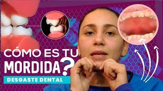 ¿mala mordida 😁😱SOLUCIONES al DESGASTE DENTAL [upl. by Sirref543]