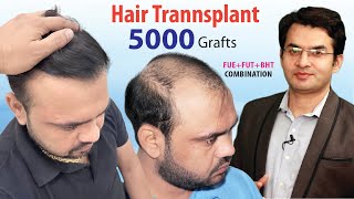 5000 Grafts Hair Transplant Results in Grade 6 by Dr Suneet Soni at Medispa Hair Transplant [upl. by Lesig]