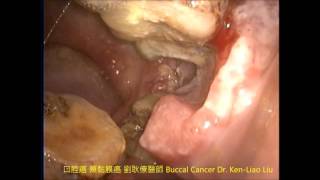 口腔癌 頰黏膜癌 Left buccal cancer Dr KenLiao Liu [upl. by Stargell]