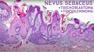 Tumors Growing from Nevus Sebaceus Trichilemmoma amp Trichoblastoma Dermpath in 5 Minutes [upl. by Raab493]