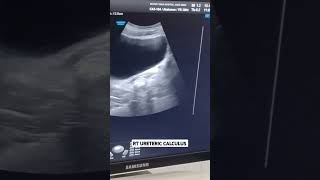 RT URETERIC CALCULUS usg humanbody radiology urinarybladder [upl. by Nosloc]