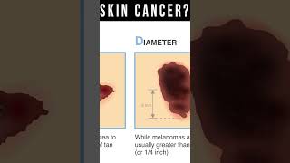 What Does Skin Cancer Look Like Symptoms Pictures Types [upl. by Iad]