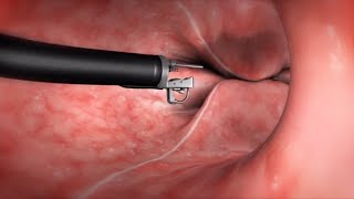 What Happens During the Endoscopic Sleeve Gastroplasty ESG Procedure [upl. by Katinka]