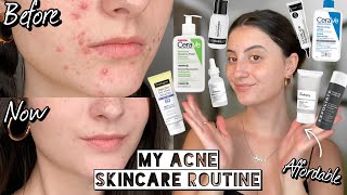 How I Cleared My HORMONAL ACNE amp SCARRING with Affordable Skincare  Dry amp Sensitive Skin [upl. by Mailiw]