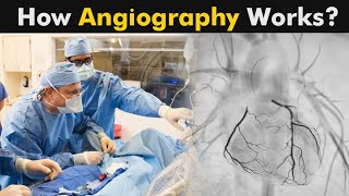 What is Angiography  How Coronary Angiography works UrduHindi [upl. by Korella236]