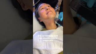 Morpheus 8 treatment at YPS morpheus8 morpheus skintreatment skintightening face neck [upl. by Nahtanod]