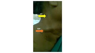 External and Internal Jugular vein pulsations [upl. by Ecinehs336]