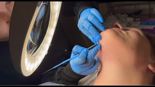 165 Hours of Electrolysis  Permanent Facial Hair Removal TimeLapse  PCOS Hirsutism [upl. by Esilec19]