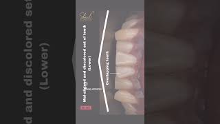 Smile design treatmentSmile correctionBest dentist in CoimbatoreDr ArshadShaad Aesthetics dental [upl. by Axe]