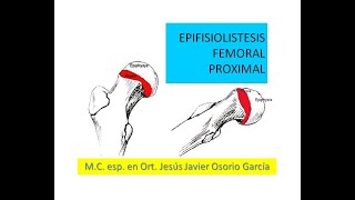 Epifisiolistesis Femoral [upl. by Anelahs]